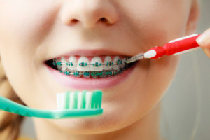 Girl with teeth braces using interdental and traditional brush